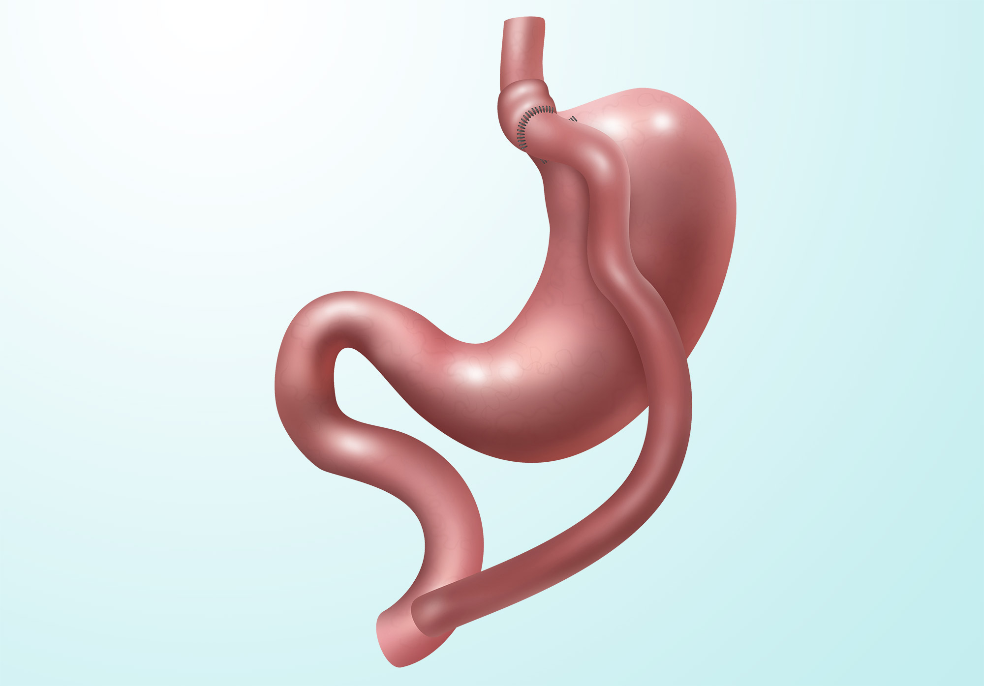 gastric bypass diabetes