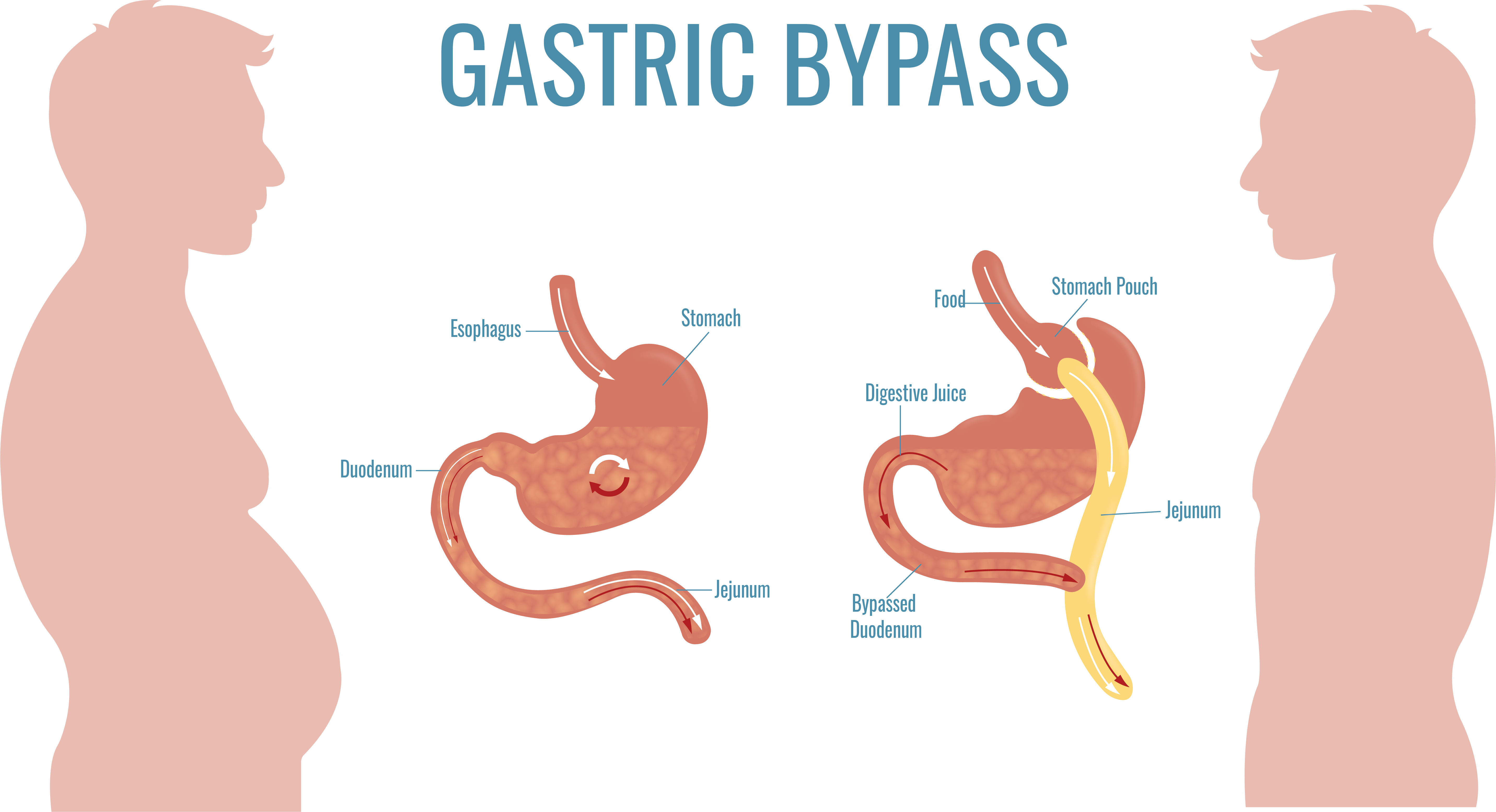 gastric bypass weight gain