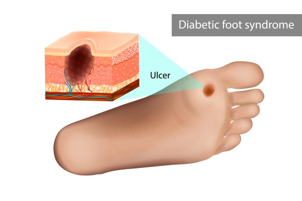 Diabetic Foot Ulcer