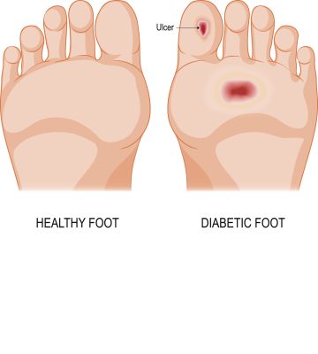 Managing Blood Sugar