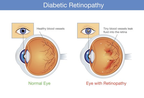 How Diabetes Affects Vision