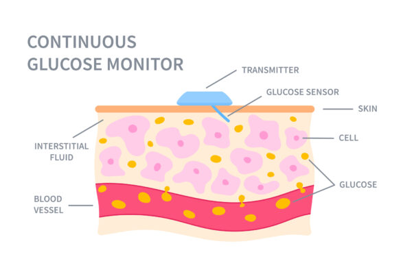 Continuous glucose sugar monitor